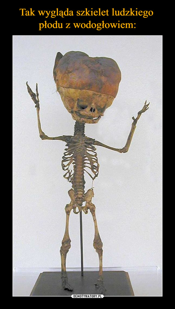 Tak wygląda szkielet ludzkiego 
płodu z wodogłowiem:
