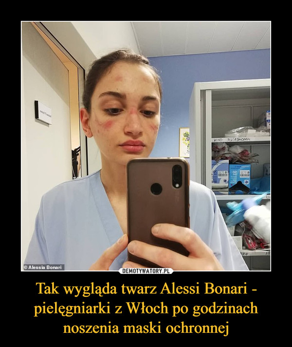 Tak wygląda twarz Alessi Bonari - pielęgniarki z Włoch po godzinach noszenia maski ochronnej –  