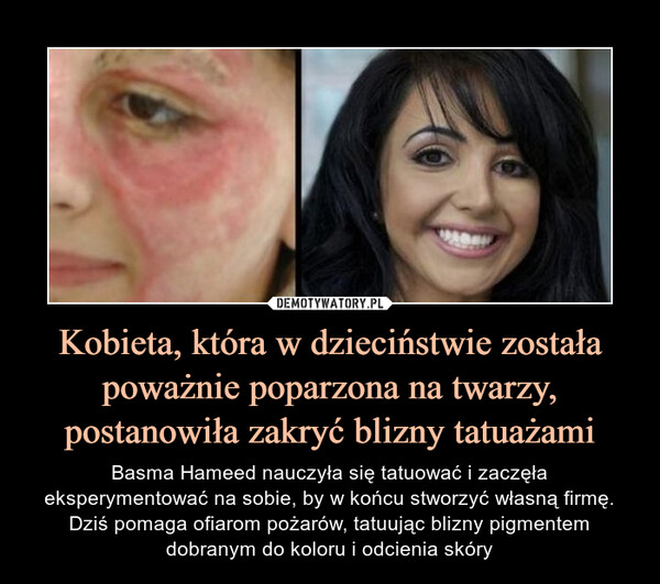 Kobieta, która w dzieciństwie została poważnie poparzona na twarzy, postanowiła zakryć blizny tatuażami